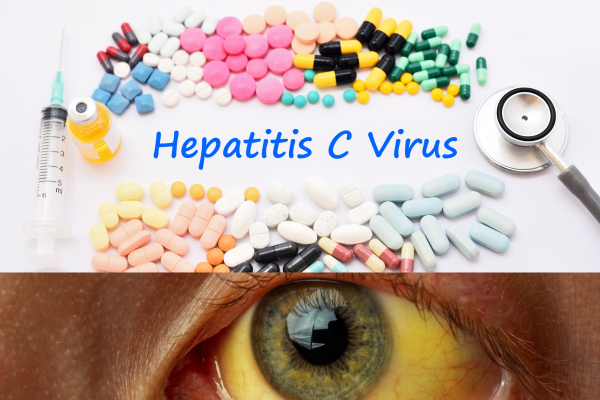 Hepatitis C