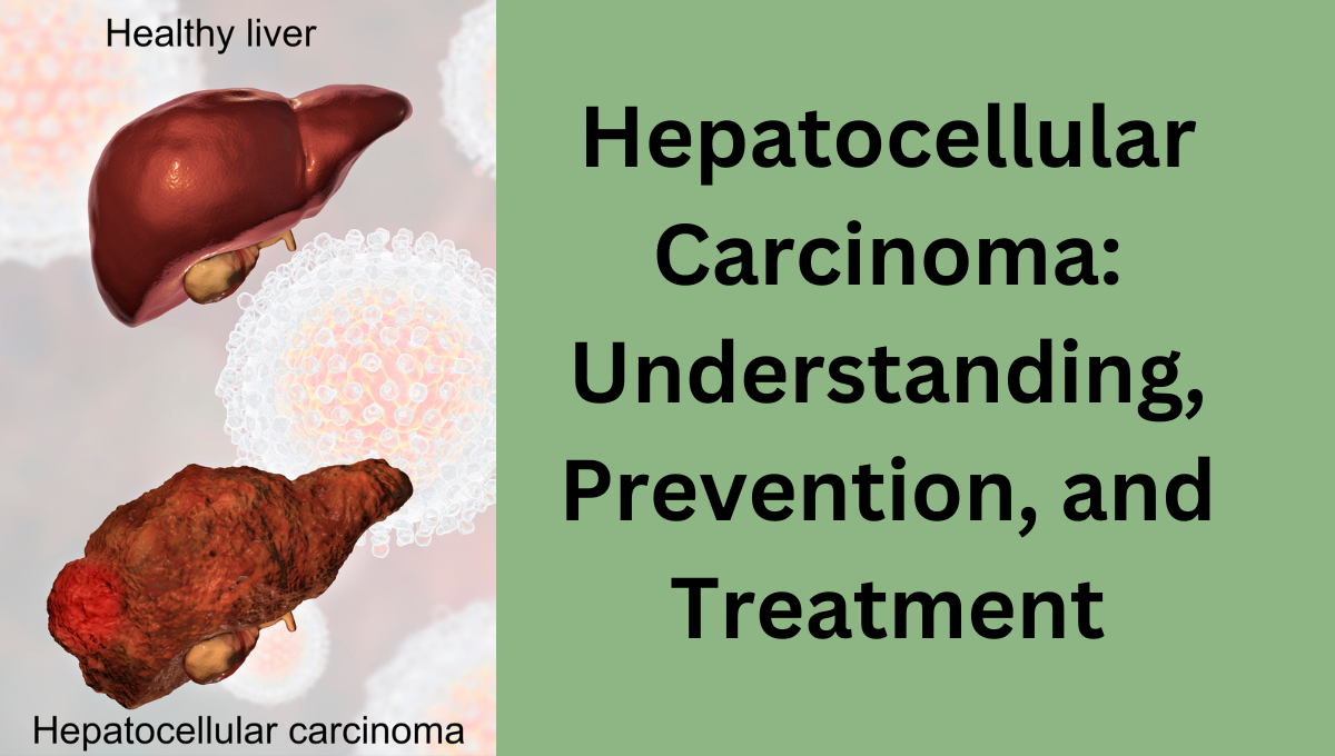 Hepatocellular-Carcinoma-Understanding-Prevention-and-Treatment