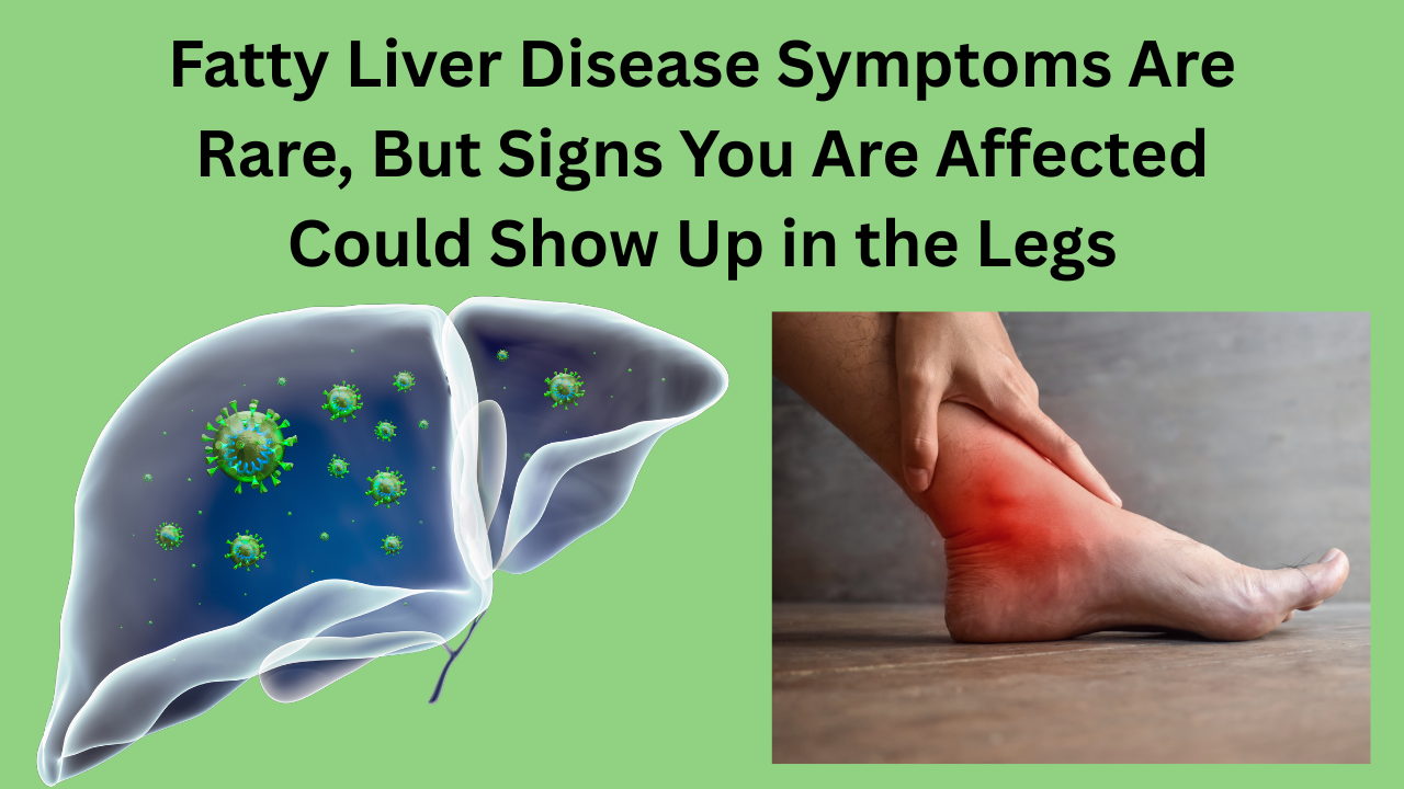 Fatty-Liver-Disease-Symptoms-Are-Rare-But-Signs-You-Are-Affected-Could-Show-Up-in-the-Legs